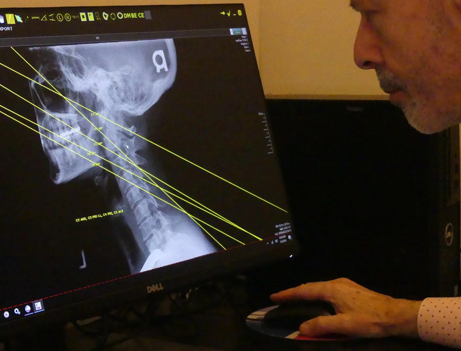 Dr. Lenarz reviewing a Blair upper cervical analysis, with measured joint angles drawn over a cervical spine image